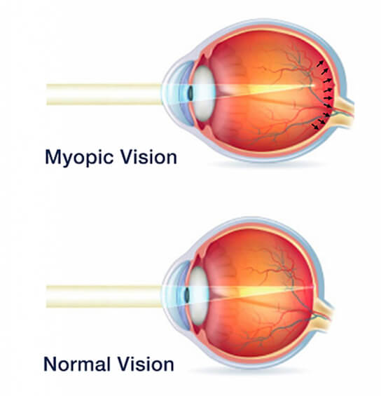 Diagram comparing a normal eye with a myopic eye where light focuses in front of the retina